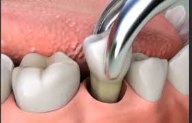 Services tooth extraction