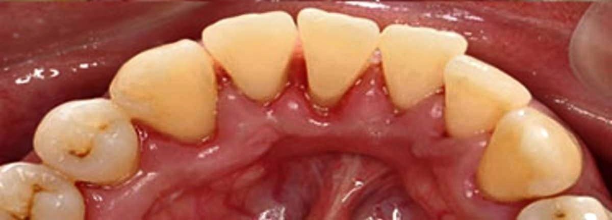 The same teeth after scaling and polishing at DentoWorld