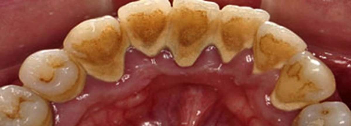 Teeth before professional scaling, with tartar built up along the gumline
